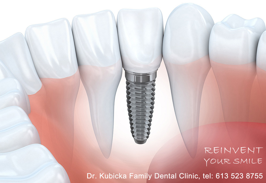 Dental Implant Procedure at Family Dental Clinic