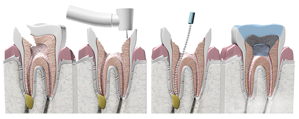 Root Canal procedure at Family Dental Clinic 